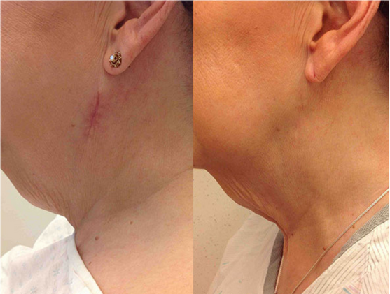 Before and after of a Female patient treated with MOH’s Surgery for Skin Cancer removal located on left upper jawline.