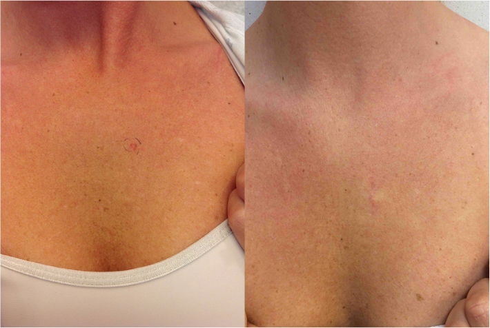 Before and after of a Female patient treated with MOH’s Surgery for Skin Cancer removal located on the chest.