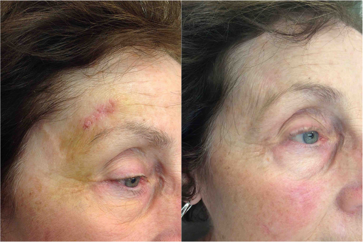 Before and after Female patient treated with MOH’s Surgery for Skin Cancer removal located above upper right eyebrow.