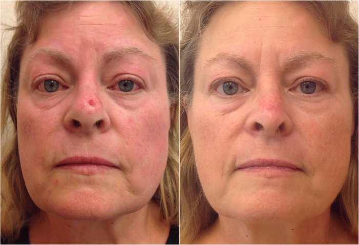 Before and after of a Female patient treated with MOH’s Surgery for Basal Cell Carcinoma Skin Cancer removal located on nose.