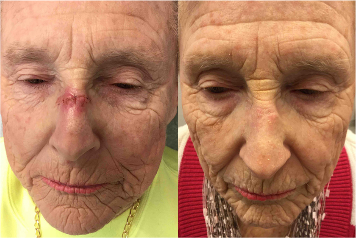 Before and after of a Female patient treated with MOH’s Surgery for Squamous Cell Carcinoma Skin Cancer removal located on bridge of nose, results; one month post treatment.