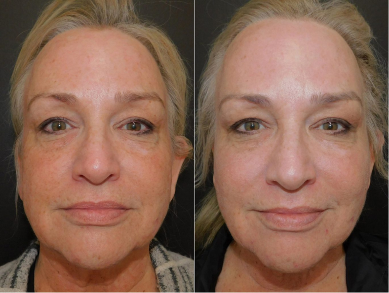 Before and after of a 61-year-old patient was treated with ThreeForMe™ 