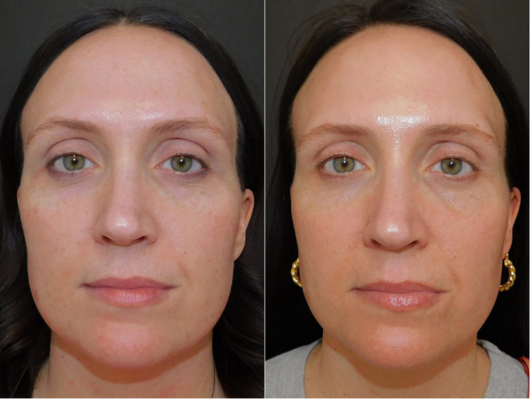 Before and after of a 40-year-old patient was treated with ThreeForMe™