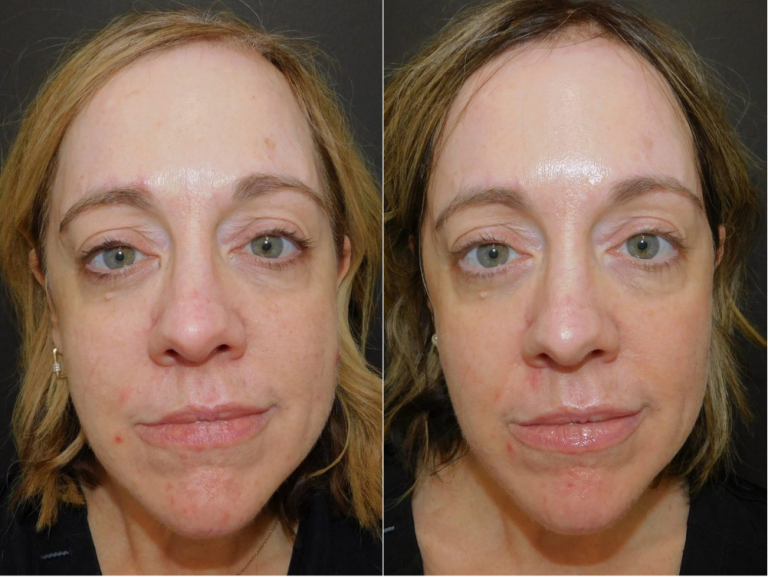 Before and after of a 52-year-old patient was treated with ThreeForMe™