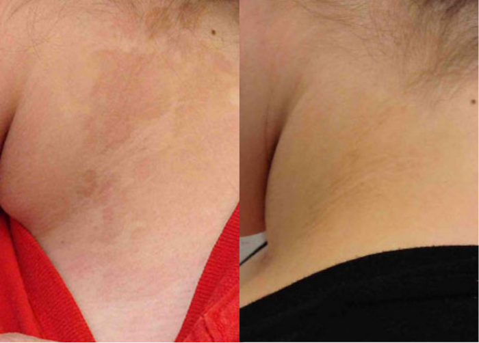 Before and after of a female patient treated for Tinea Versicolor located on the neck to improve the appearance of discoloration.