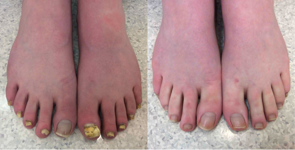 Toenail Fungus Treatment Before and After