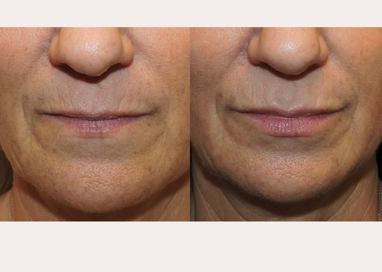 Before and after of a A 49-year-old Female patient treated with Juvederm Volbella Filler