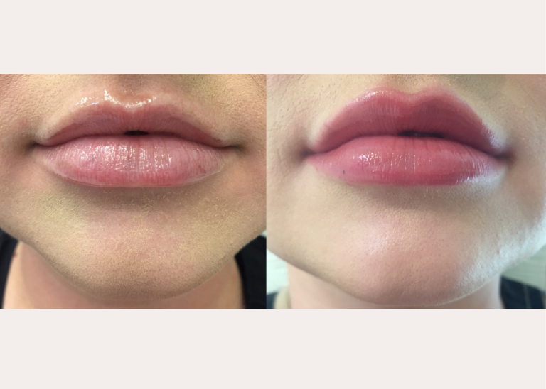 Before and after of a 28-year-old Female patient treated with Juvederm Volbella Filler to increase lip volume. 