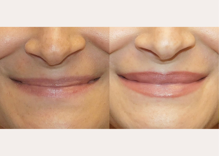 Before and after of a A 21-year-old Female patient treated with Juvederm Filler to increase lip volume