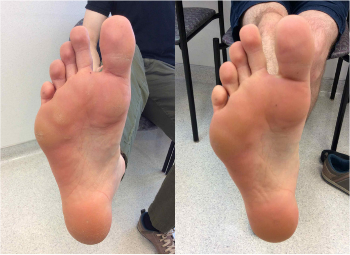 Before and after of a Male patient treated for Wart Removal with DNCB Treatment located on bottom of foot.