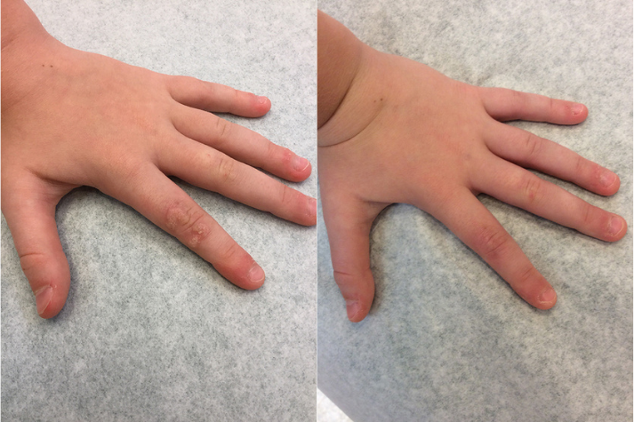 Before and after of aMale patient treated for Wart Removal with DNCB Treatment located on index finger.