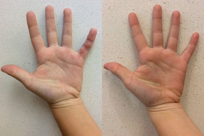 Before and after of a Male patient treated for Wart Removal with DNCB Treatment located on pinky finger.