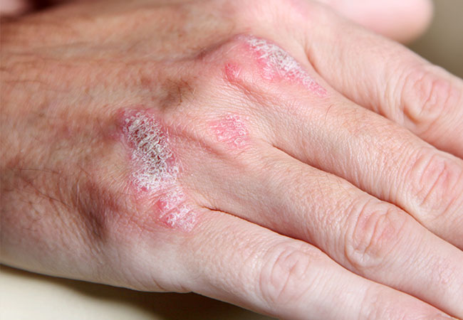 psoriasis-on hand