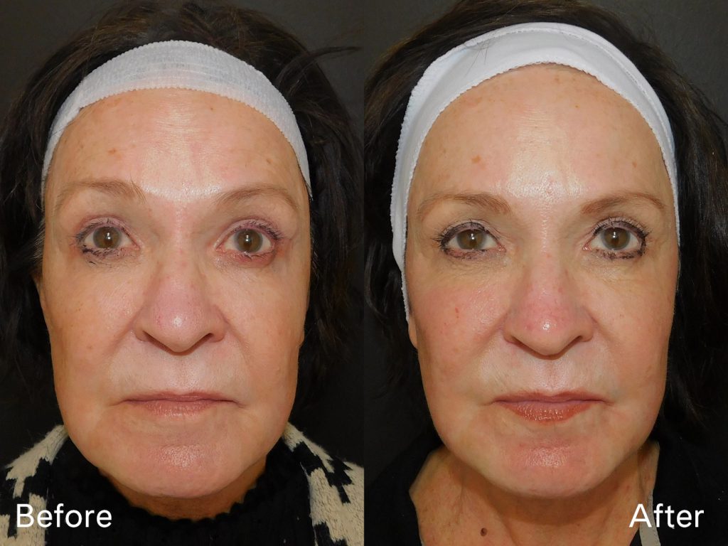 Before and after of woman who received Halo treatment front on (10 days post procedure)