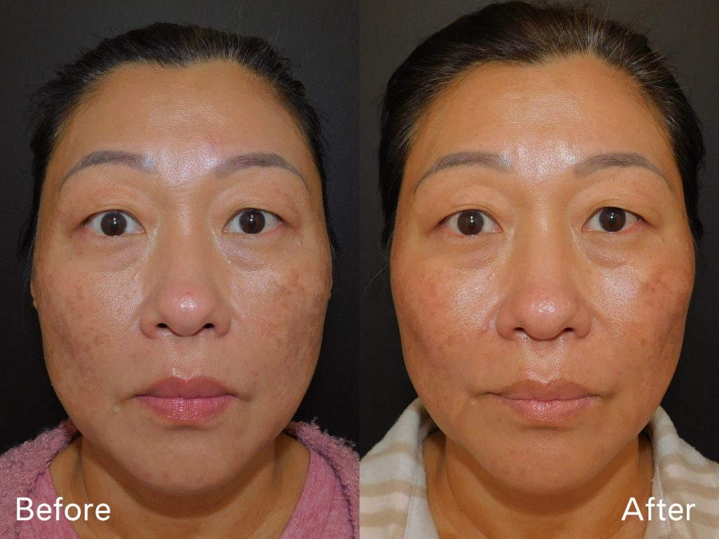 Before and after of woman who received Moxi treatment front on (10 days post procedure)