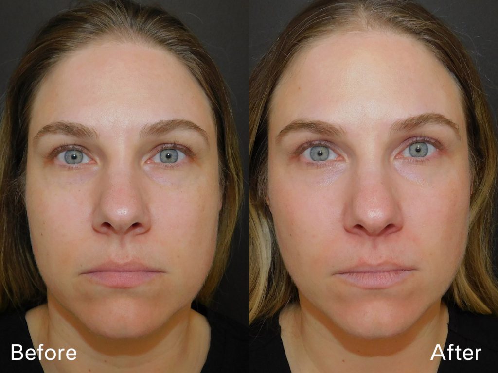 Before and after of woman who received Moxi treatment front on (11 days post procedure)