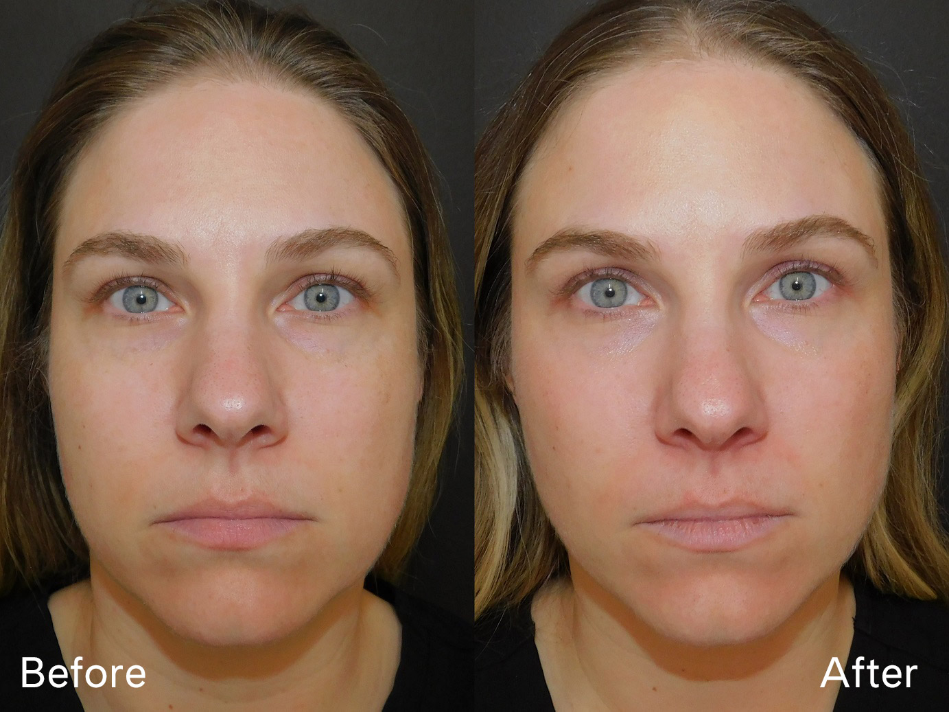 Moxi Laser Treatment Before and After