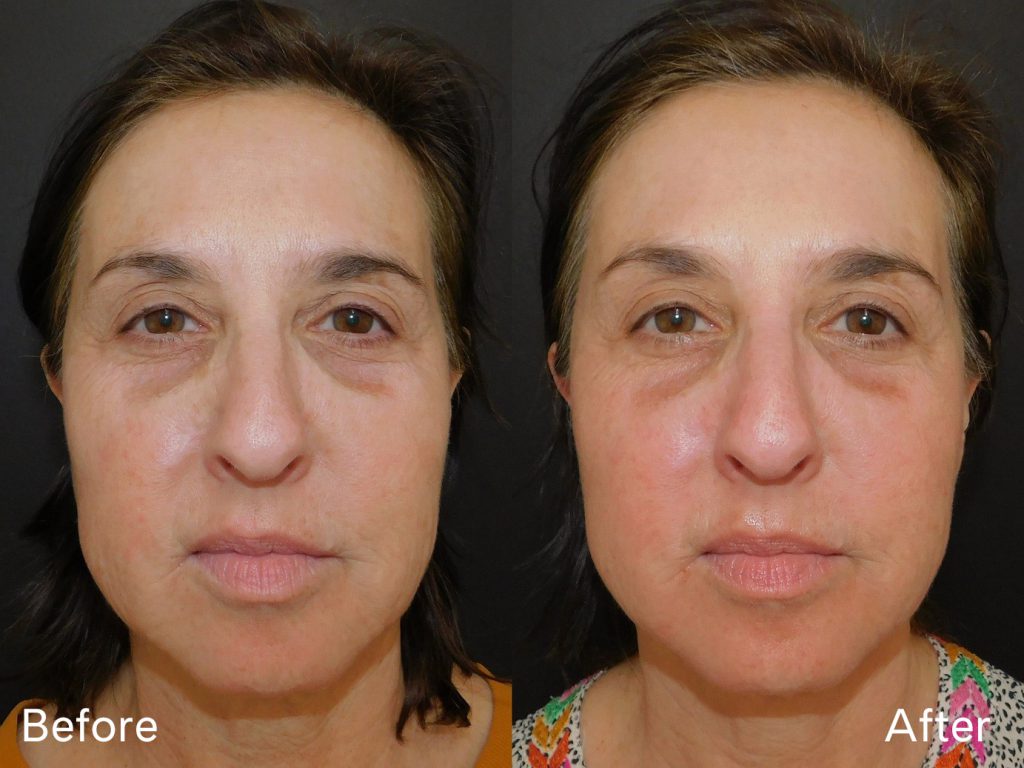 Before and after of woman who received Halo treatment front on (20 days post procedure)