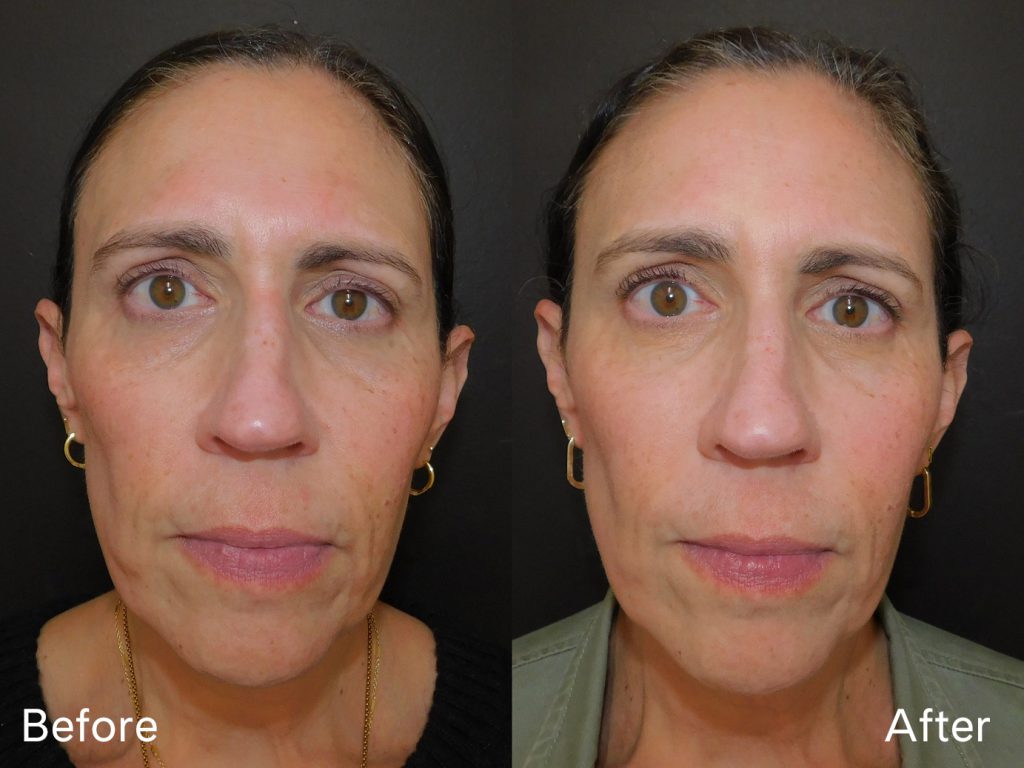 Before and after of woman who received Moxi treatment front on (6 days post procedure)