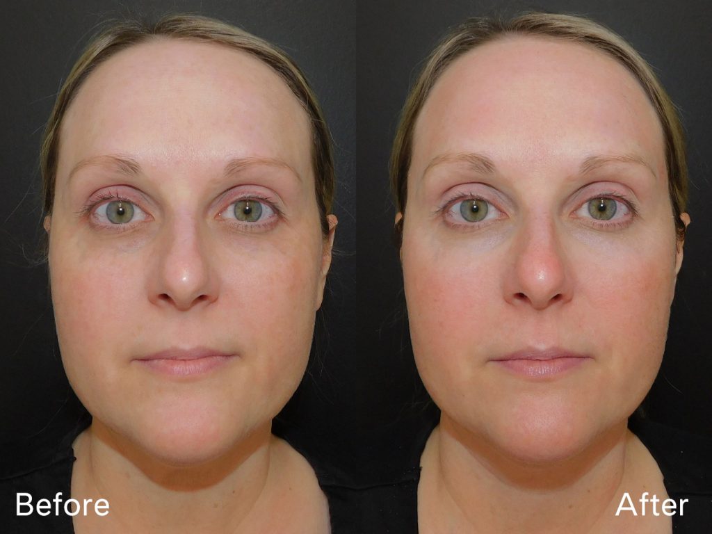 Before and after of woman who received Halo treatment front on (7 days post procedure)