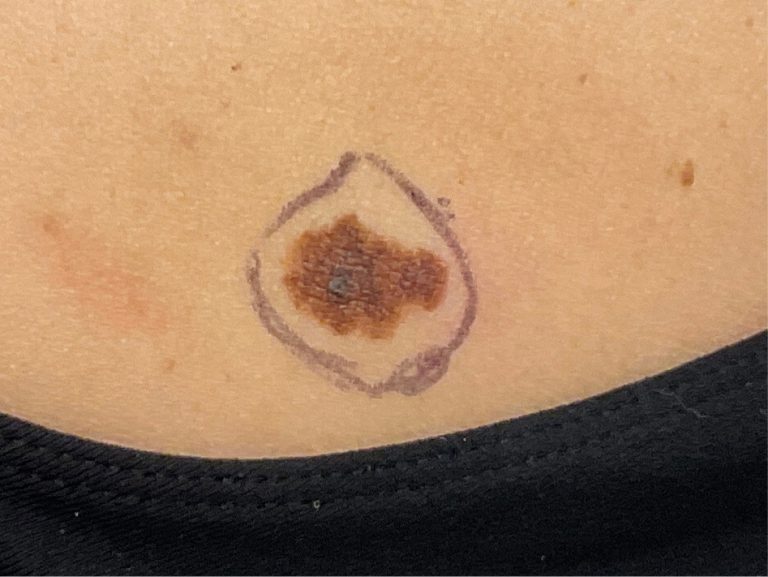 close up of melanoma