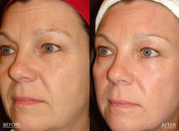 Fraxel laser before and after