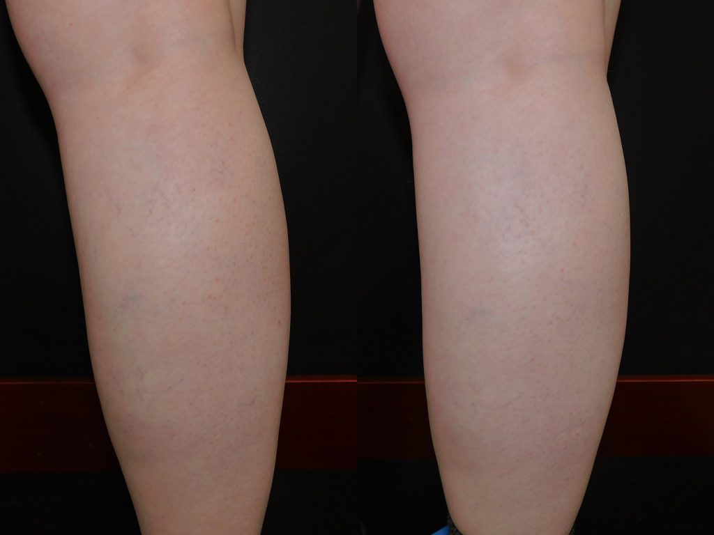 right calf leg veins before and after photo