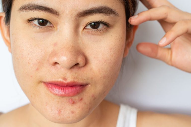 Well-rounded teenage acne solutions