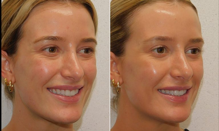 SKINVIVE Before and After