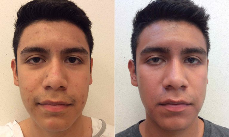 Before and after of male with acne