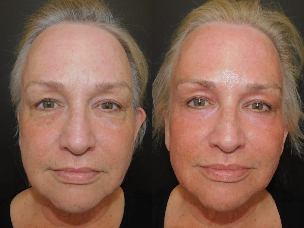 Contour TRL Before and after