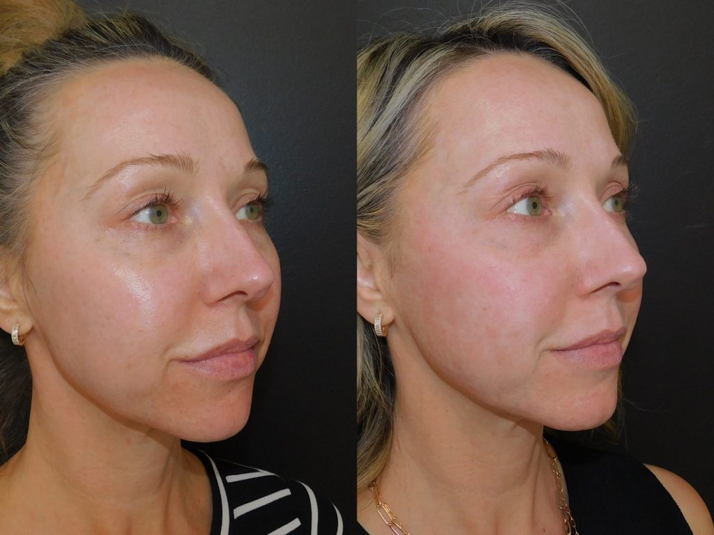 Micro laser Peel Before and After