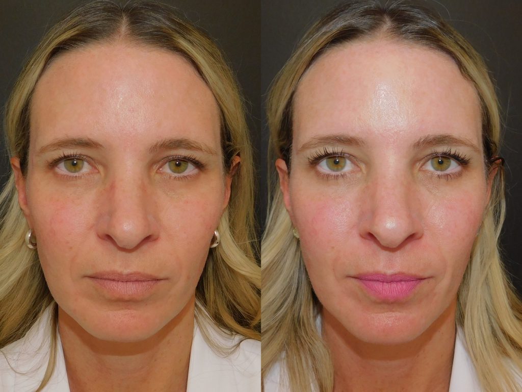 nano laser peel before and after