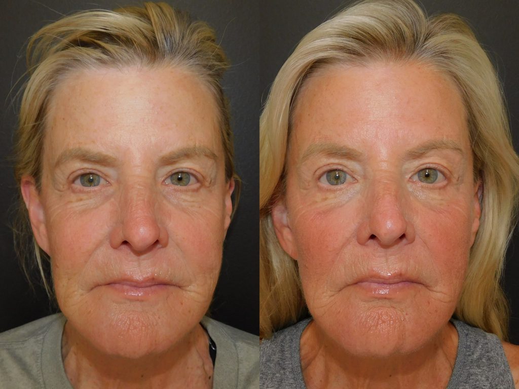 ProFractional laser before and after