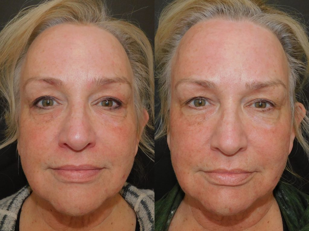 ProFractional laser before and after