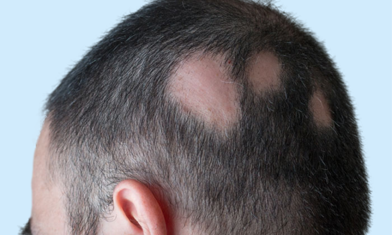 Treating alopecia and other hair loss