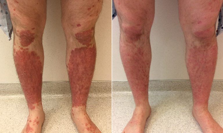 20240729 understanding psoriasis blog post 800x533