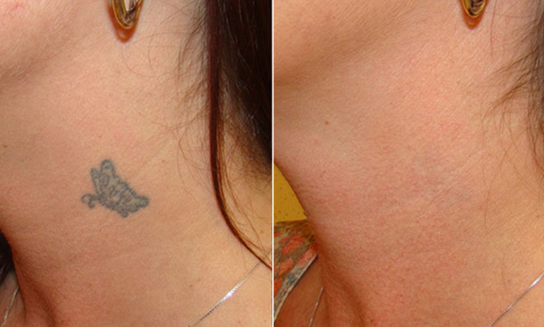 What to expect when getting laser tattoo removal