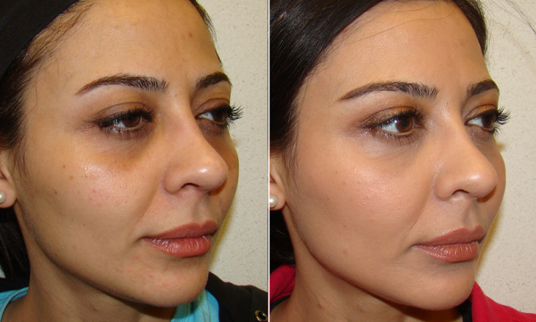 Fillers & BOTOX® that look natural and fresh! Where to go and why?