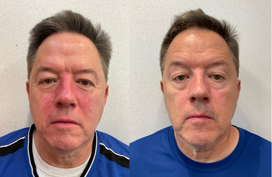 Rosacea Treatment Before and After Patient male 6