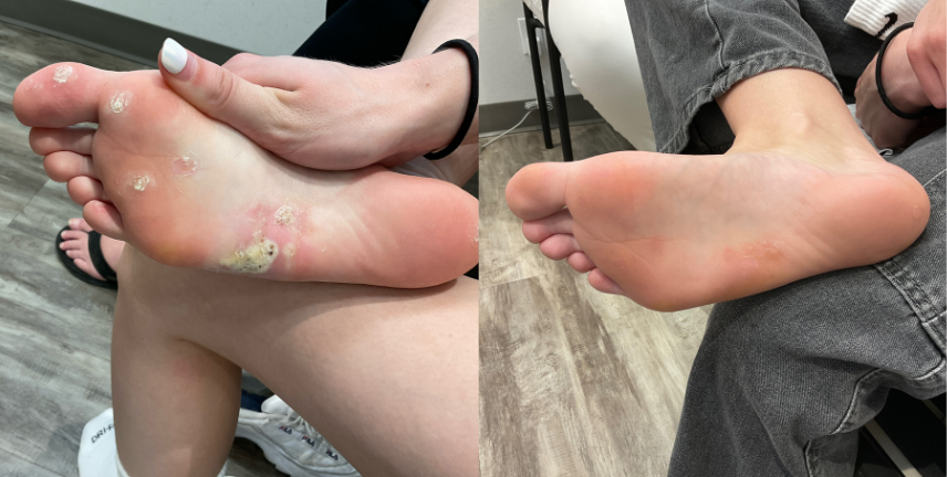 Wart Removal Before and After Patient 6.png