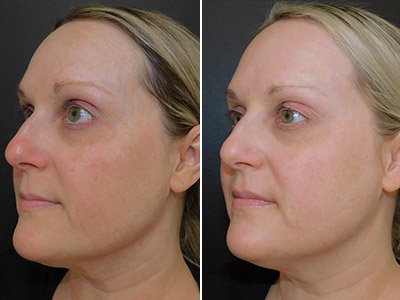 A beginners guide to fractional laser skin rejuvenation treatments