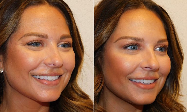 Jeuveau vs BOTOX: Which is best for you?