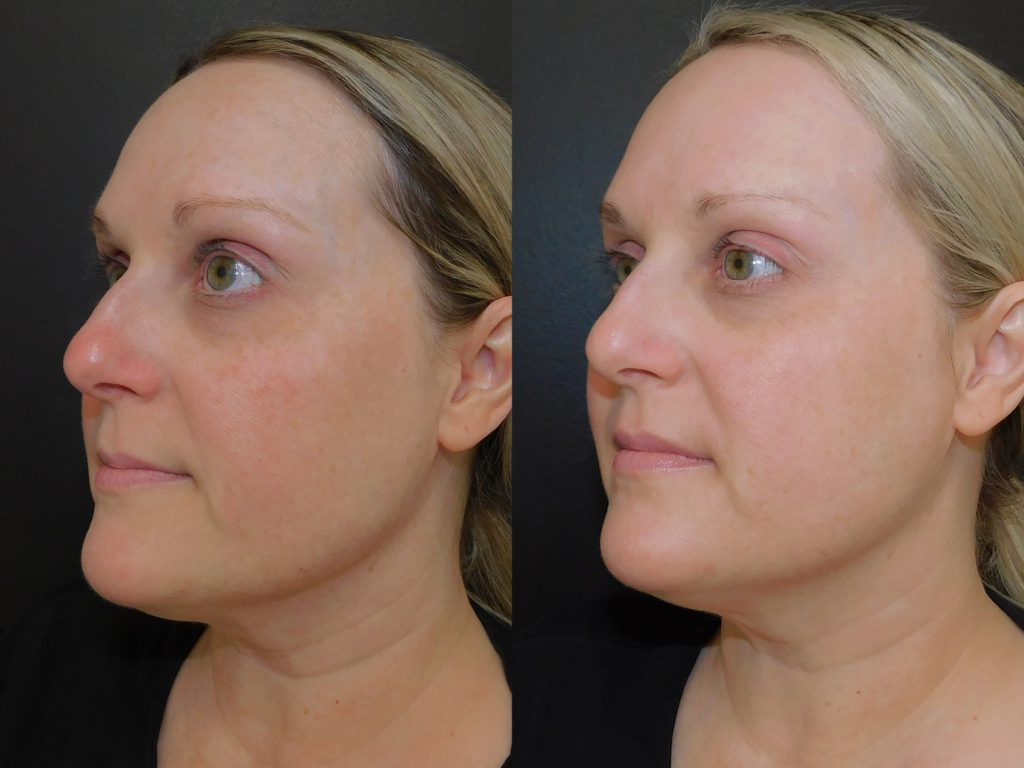 Before and after of female patient who has had HALO performed on her at Schlessinger MD