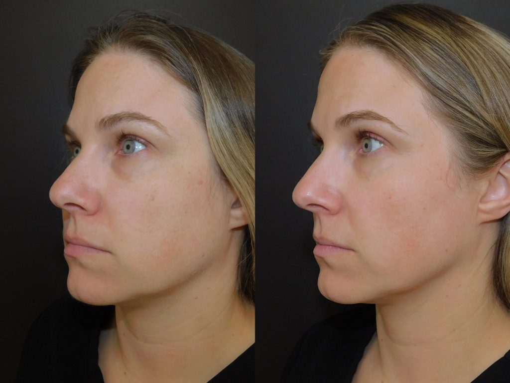 Before and after of female patient who has had MOXI performed on her at Schlessinger MD