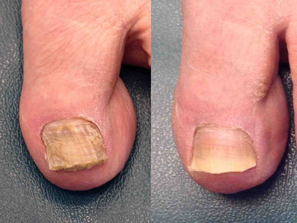 Before and after of a patient treated for Toenail Fungus to improve the overall nail health and appearance.