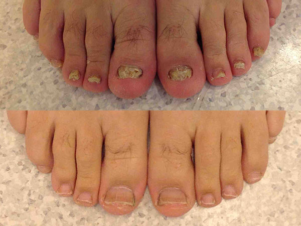 Does peroxide kill toenail fungus?