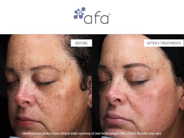 Unretouched photo from clinical trials of afa Antioxidant Facial Peel