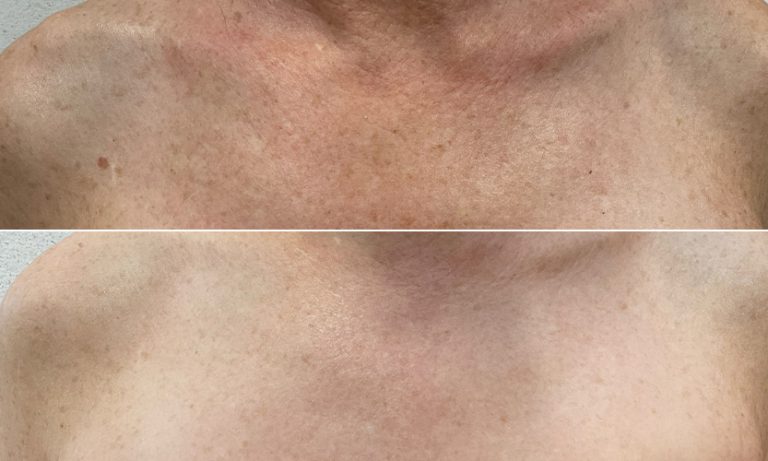 What to expect during and after HALO laser skin resurfacing