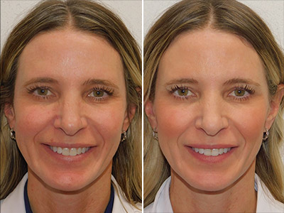 What is Sculptra and how is it different from other cosmetic injections?